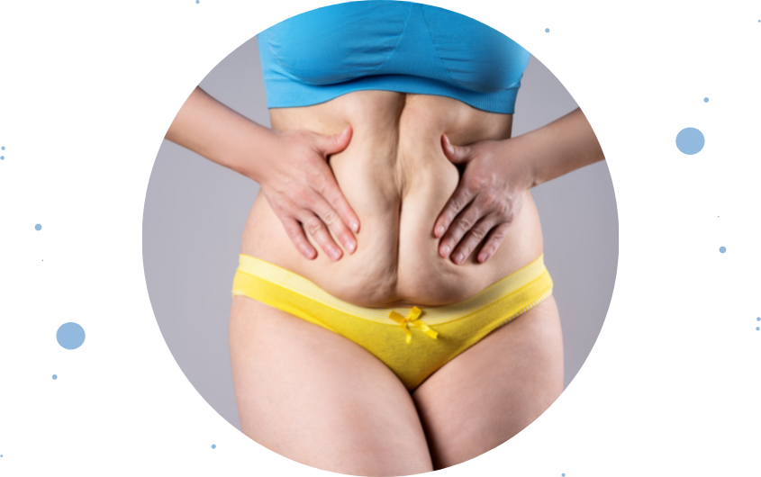 Abdominoplastia