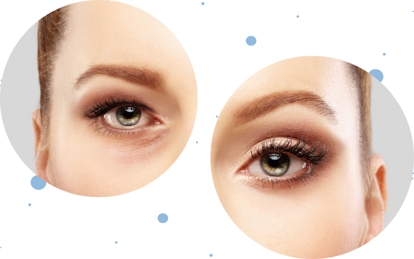 Blefaroplastia