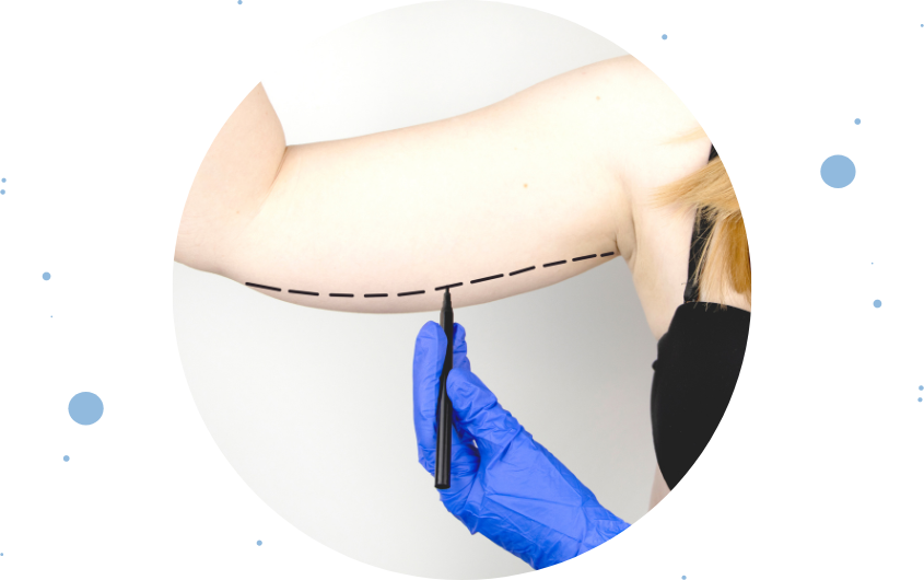 Braquioplastia