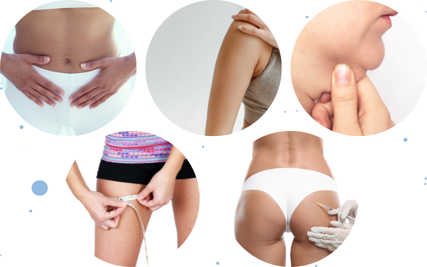 Lipoescultura